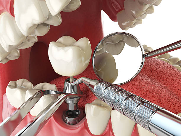 Best Chipped Tooth Repair Near Me  in Lyons, KS